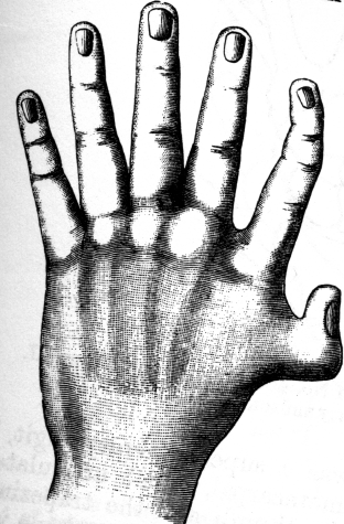 Polydactyly. A meristic variant, from Windle (1891) J. Anatomy 26, p.100 as shown in William Bateson's book - Materials for the Study of Variation (1894).