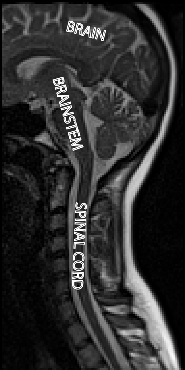 MR image of the brain, brainstem, and spinal cord