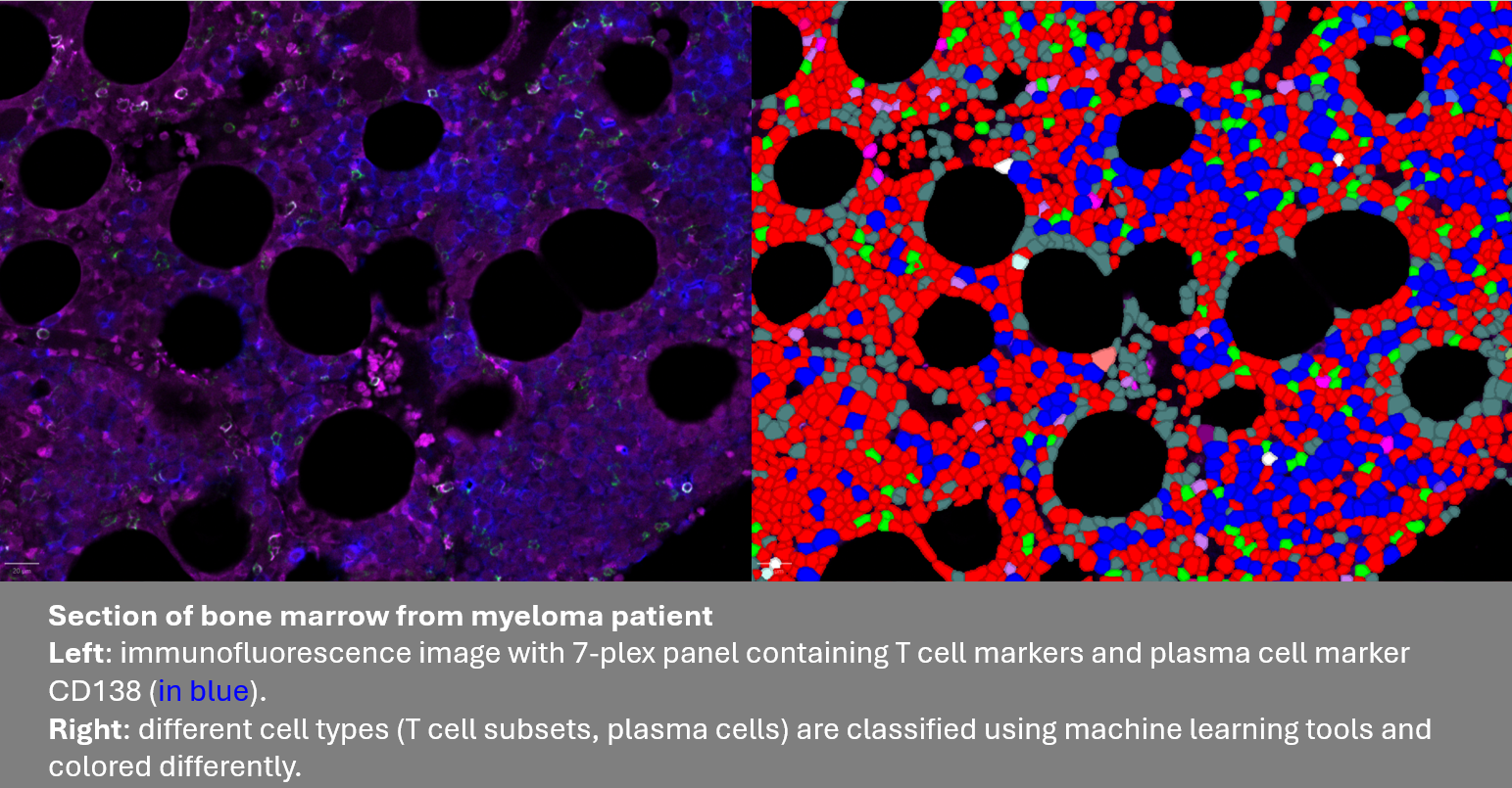 section of bone marrow from a multiple myeloma patient