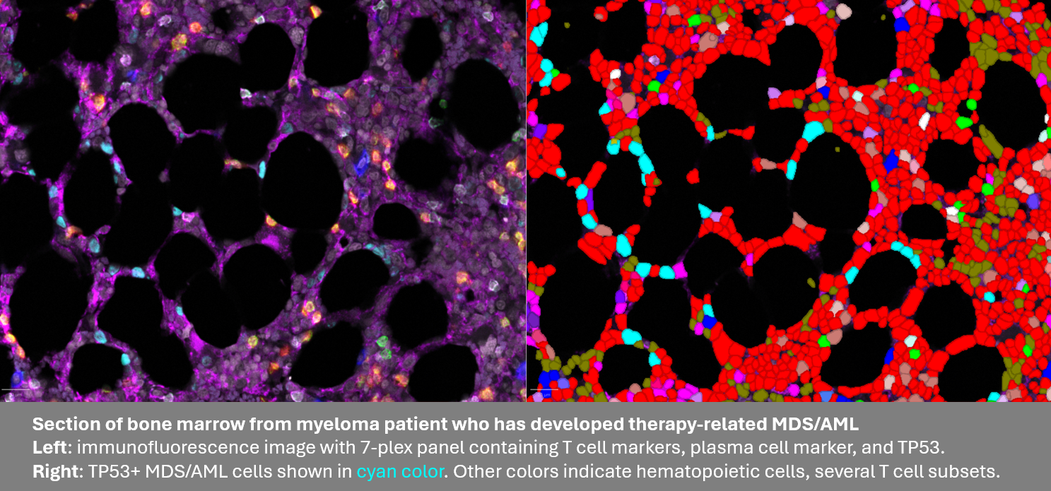 section of bone marrow from a multiple myeloma patient who has developed therapy-related MDS/AML