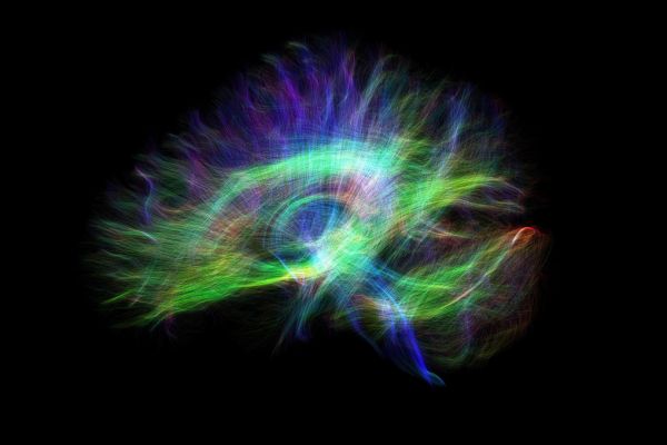 Diffusion Spectrum Imaging (DSI) of neuron connections in a brain captured during Queen's research