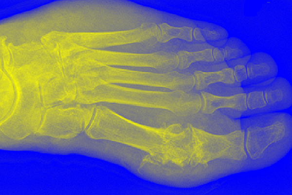 Scanned image of foot with gout