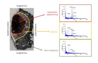 Melanoma sample with mass spectra from different regions of the sample