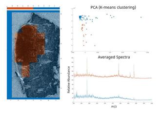 Heatmap of sample overlaid with the optical image showing the neoplastic region in orange and non‑neoplastic in blue. 