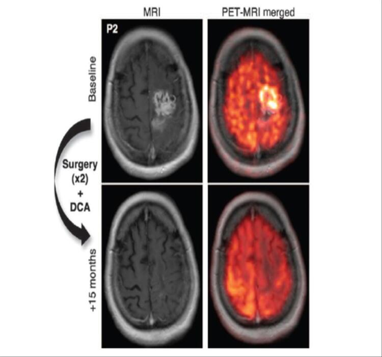 MRI Scan showing tumour regression