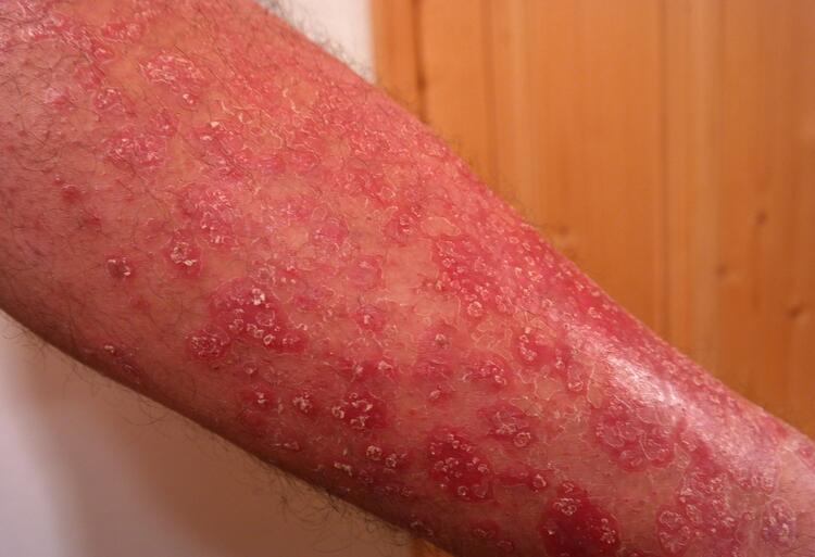 Arm with inflammed skin condition