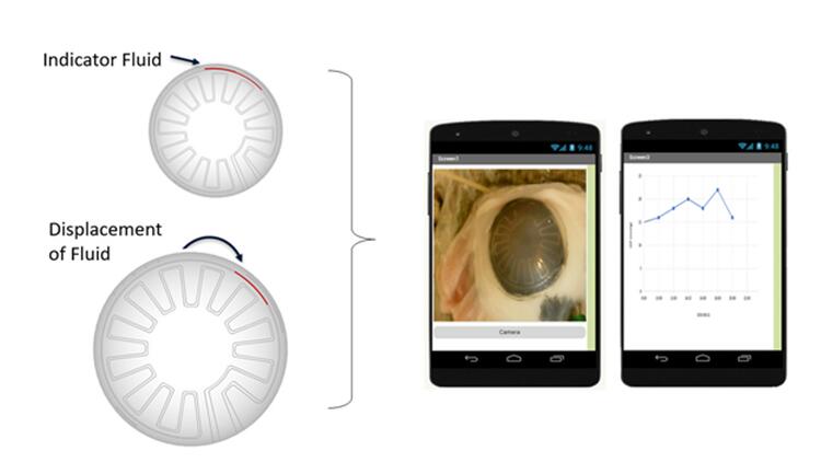IOP measurement system showing contact lens and mobile app
