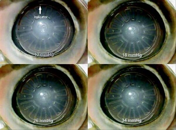 Example of the fluid indicator moving to different locations at different intraocular pressure levels