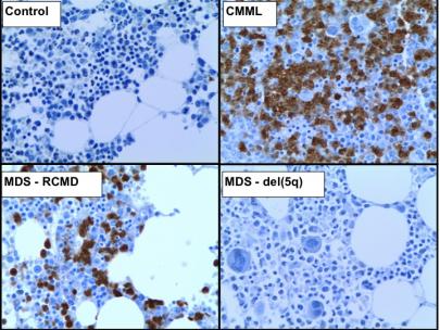 Arginase 1 immunohistochemical staining of representative control, CMML and MDS patient bone marrow biopsies.