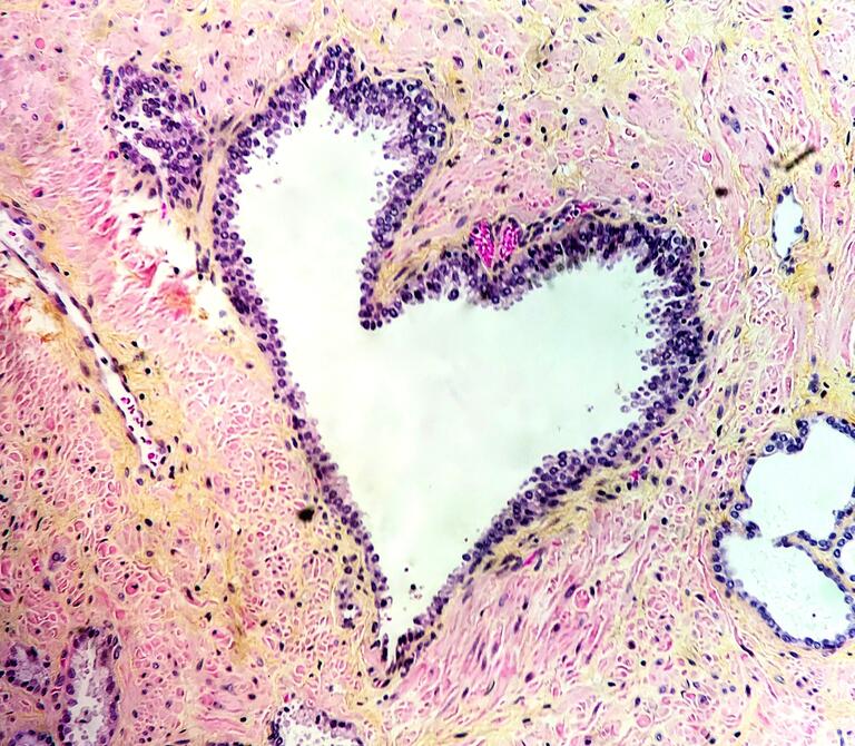 A  prostatic gland under a microscope in the shape of a heart