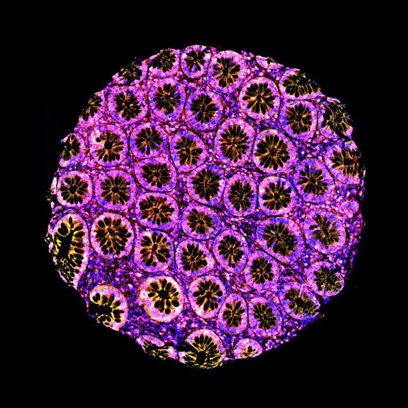 A colorectal carcinoma multiplex immunofluorescence stain