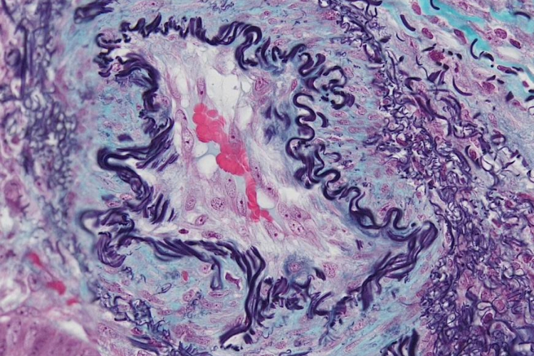 [An elastic trichrome stain producing purple, pink, and blue colours on a sample of cancerous tissue.]